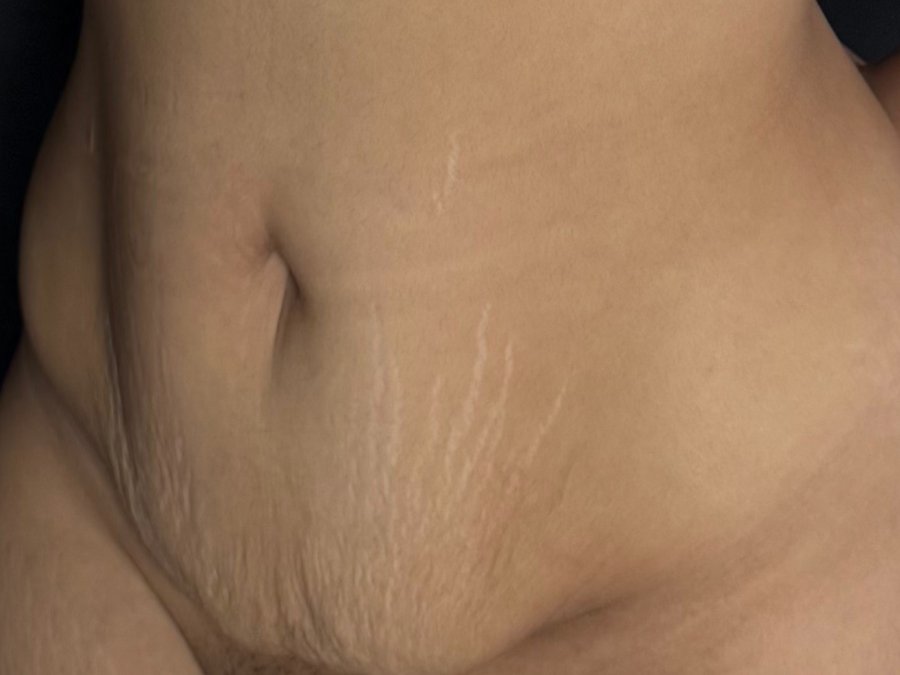 Abdominoplastia: antes da cirurgia